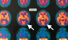 HBOT usprawnił chorobę Alzheimera